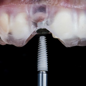 Dental implant being placed in dental arch with help of surgical guide