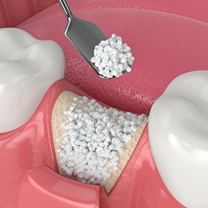 Illustration of bone being placed in tooth socket during bone graft