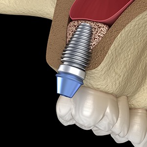 Illustration of dental implant in jaw after sinus lift