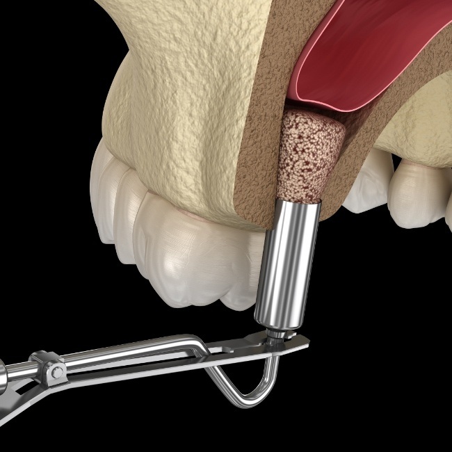 Animated smile during bone grafting process
