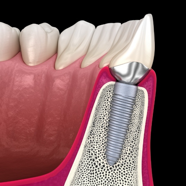 Animated smile with dental implant placed into engineered soft tissue and bone