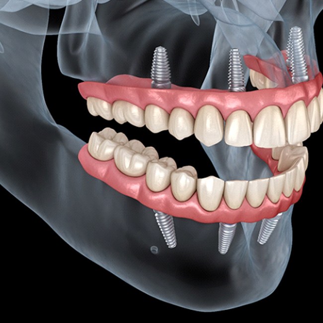 Illustration of All-on-4 in Katy for upper and lower dental arches