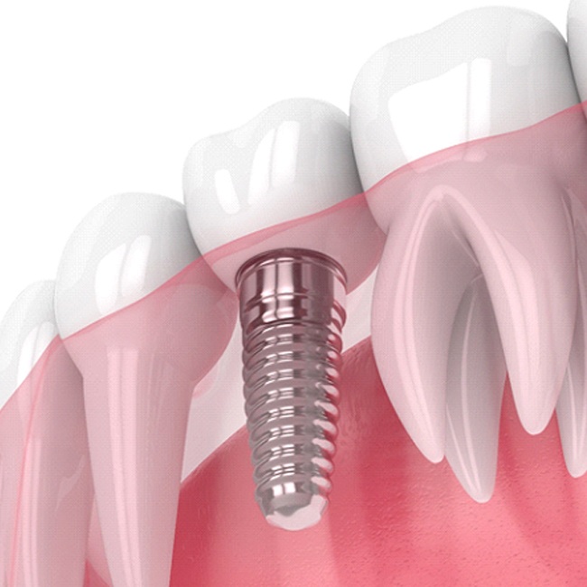 Illustration of traditional dental implant between natural teeth