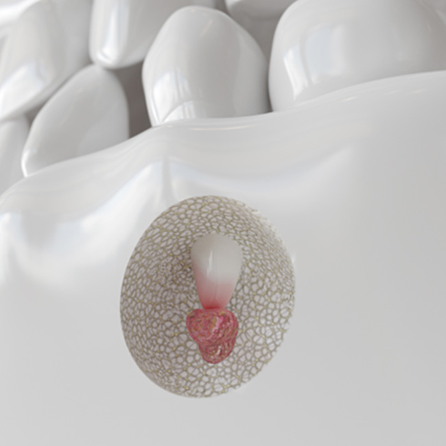 Illustration of a cyst at the root of an infected tooth