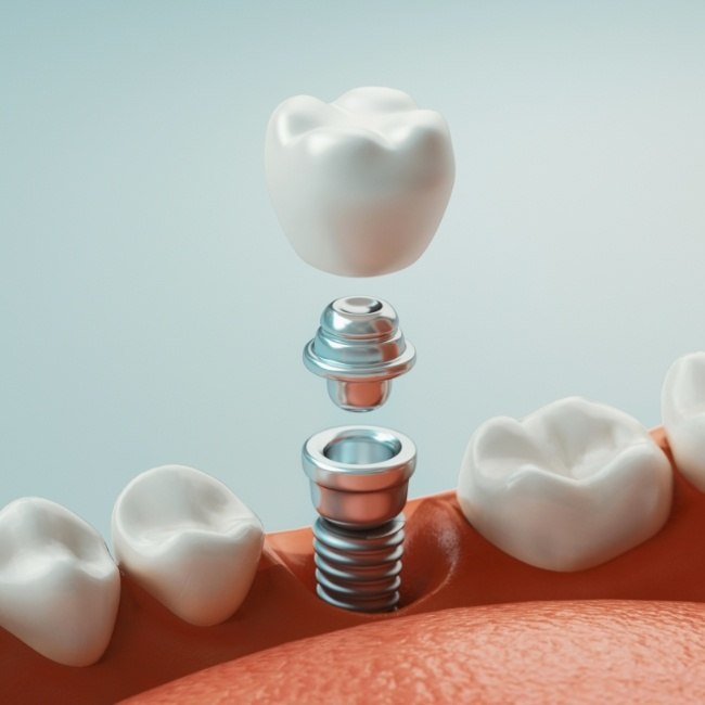 Animated smile with dental implant supported replacement tooth components being put into place