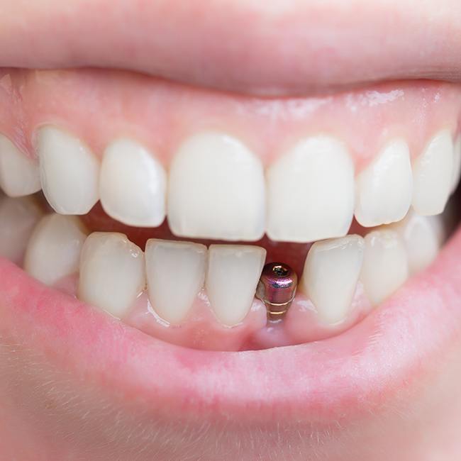 Closeup of smile with dental implant post visible