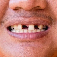 Closeup of smile with multiple missing teeth