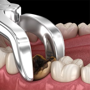 Illustration of forceps gripping severely decayed tooth