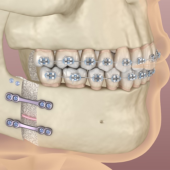 Illustration showing titanium plates in lower jaw
