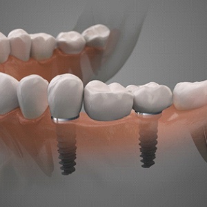 Two dental implants in jaw, supporting bone health