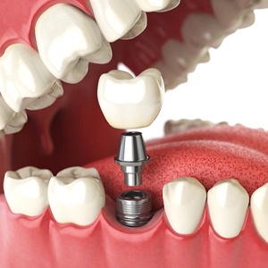 Illustration of implant, abutment, and crown in mouth