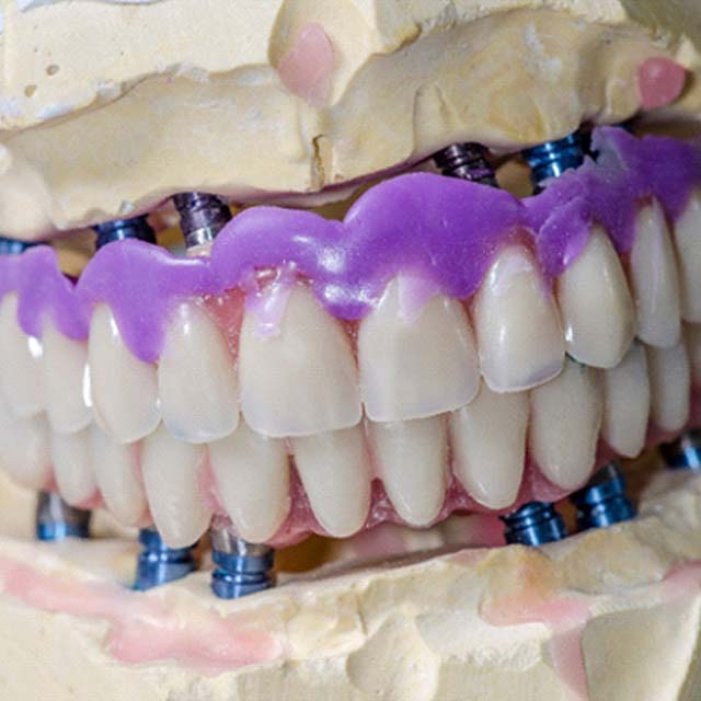 Implant dentures for both arches in process of being created