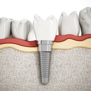 Dental implant successfully integrated with jawbone next to natural teeth