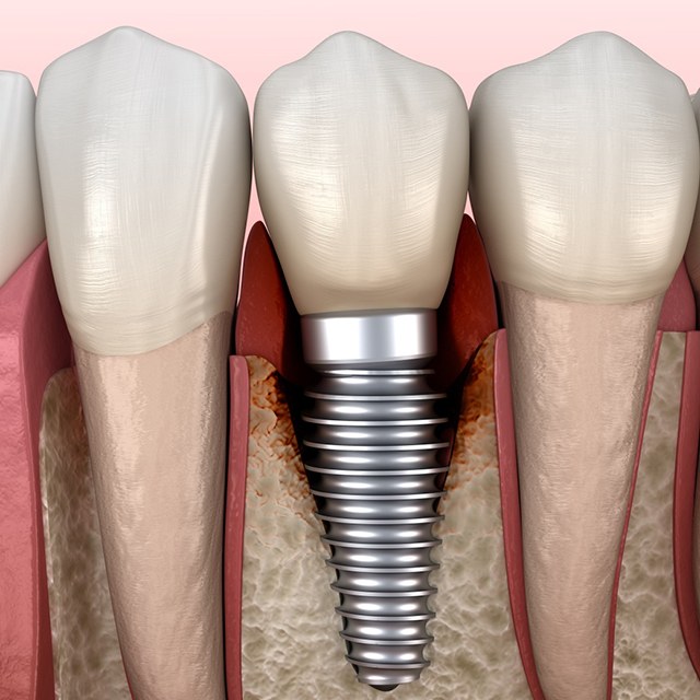 Illustration showing a failing dental implant