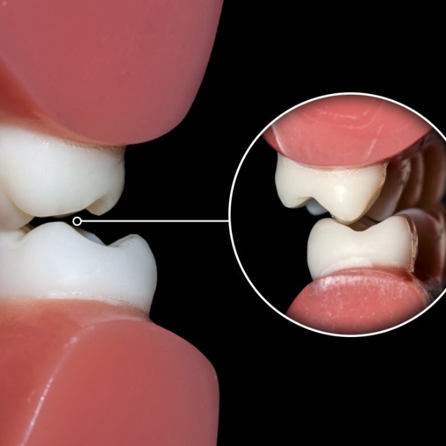 Closeup of misaligned teeth before corrective jaw surgery