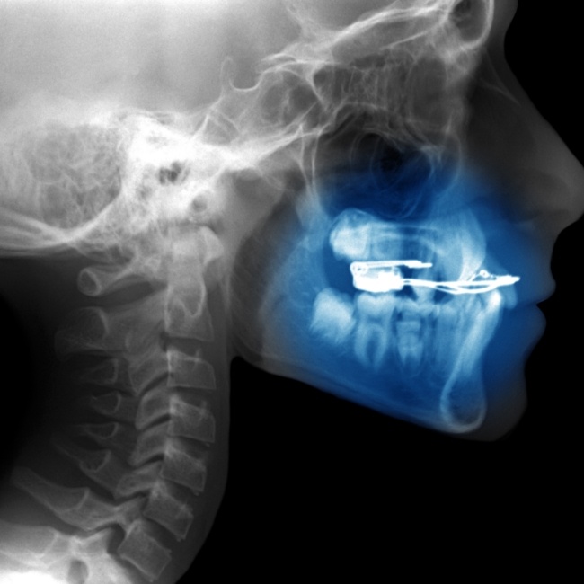X-ray of jaw and skull during oral and maxillofacial surgery pathology treatment