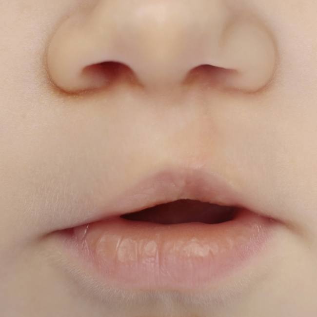 Closeup of child's smile before cleft lip and palate surgery