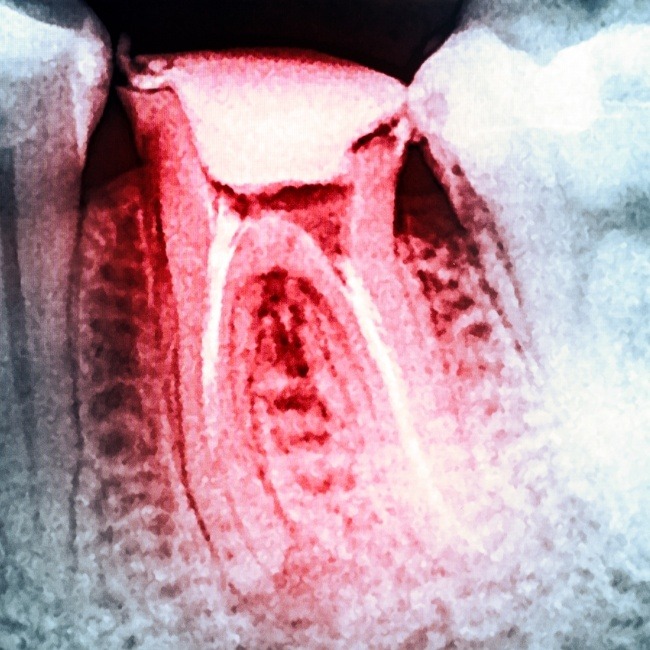X-ray of tooth after apicoectomy surgery