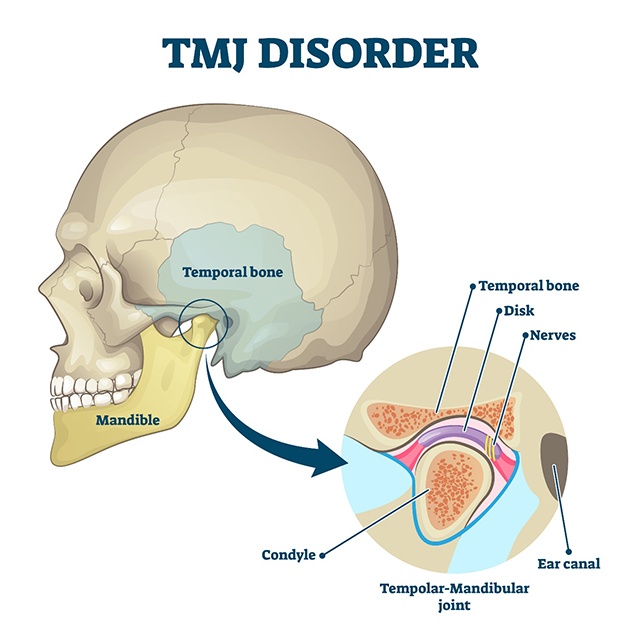 Illustrated diagram explaining the TMJ and TMJ disorder