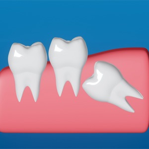 Illustration showing impacted wisdom tooth