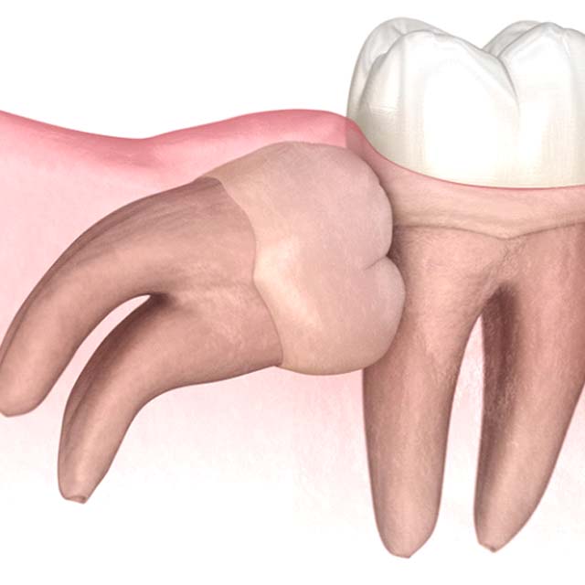 Illustration of impacted wisdom tooth pushing against adjacent molar