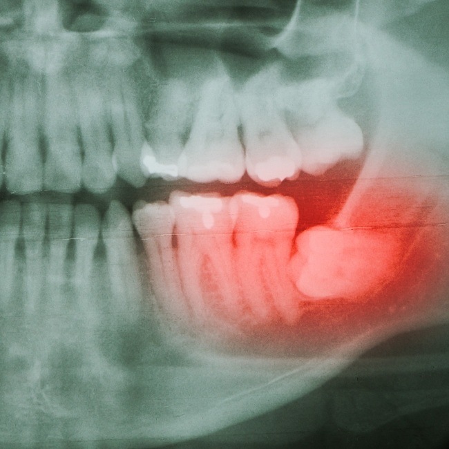 X-ray of smile with impacted wisdom tooth