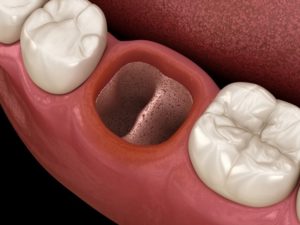 Illustration of dry socket after surgical tooth extraction