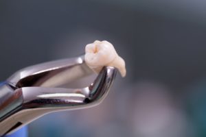 Forceps holding tooth after successful tooth extraction procedure