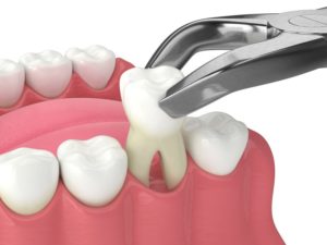 Illustration of forceps extracting tooth