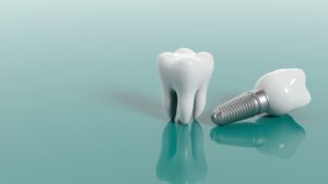 Dental implant next to natural tooth