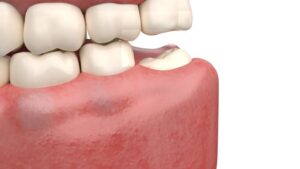 Illustration showing impacted wisdom tooth