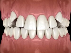 Illustration showing partially impacted canine teeth